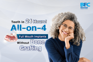 All-on-4 Full Mouth Implants