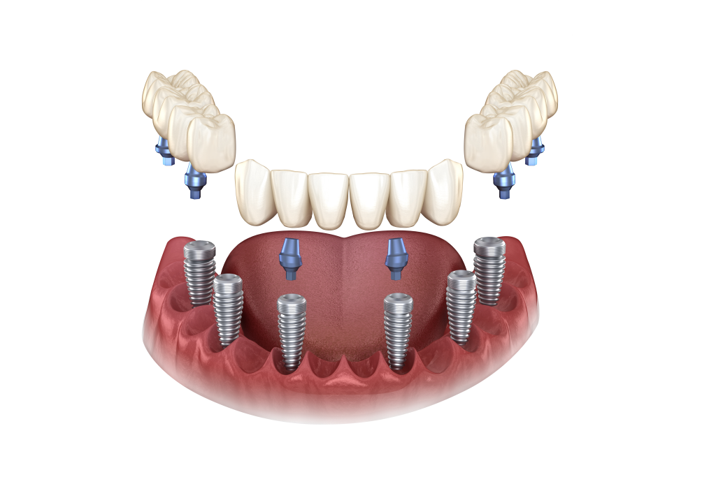 3-on-6 Dental Implants