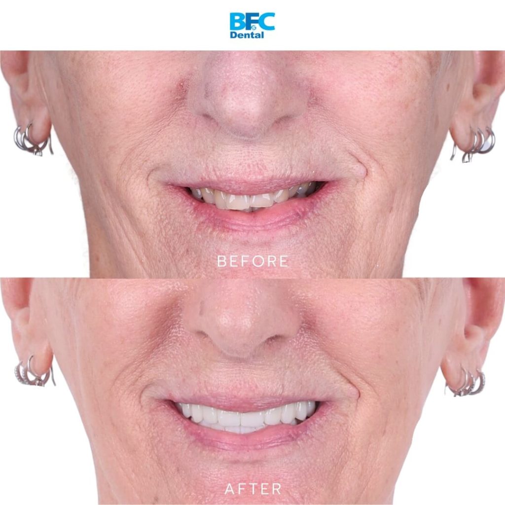 All-on-4 Dental Implants