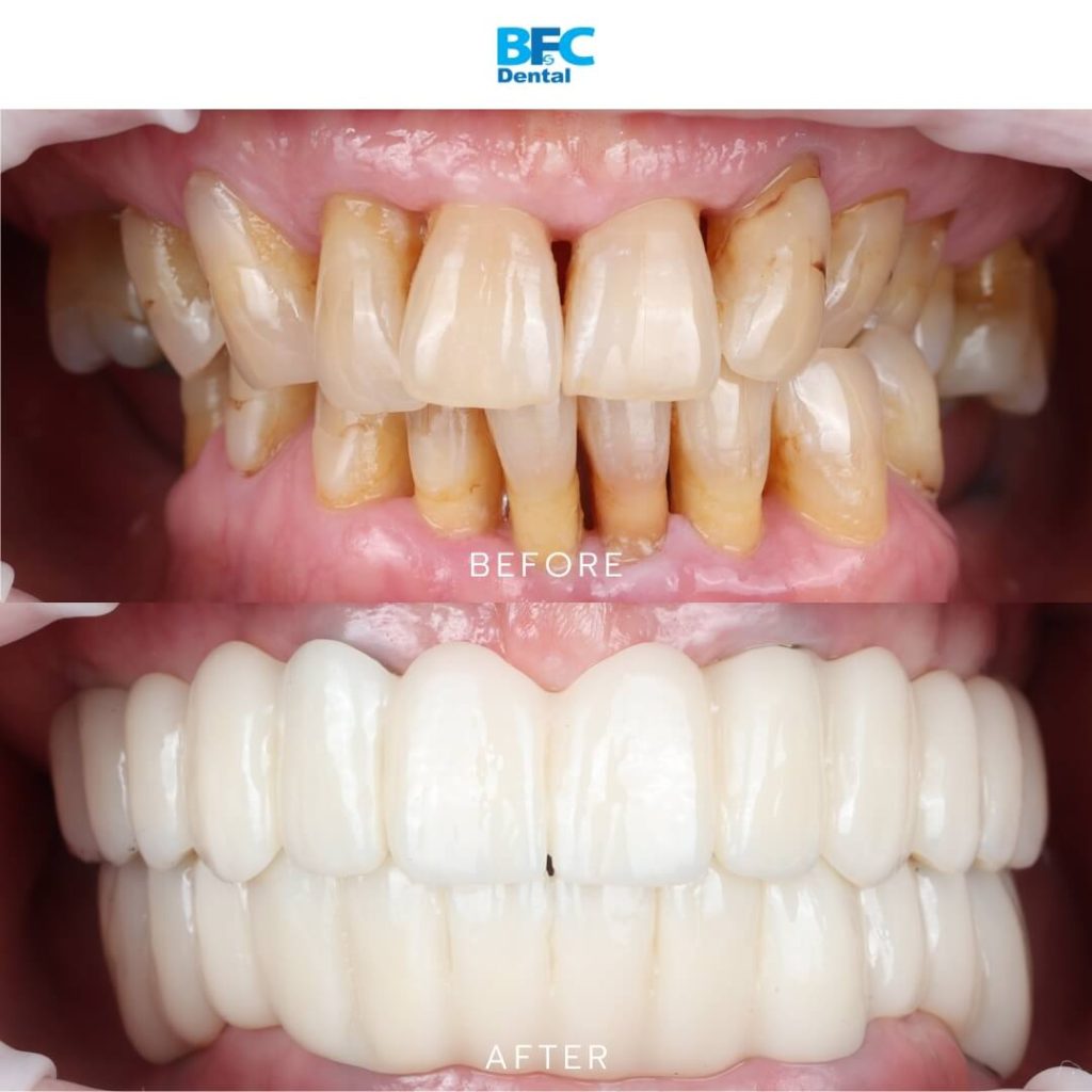 All-on-4 Dental Implants