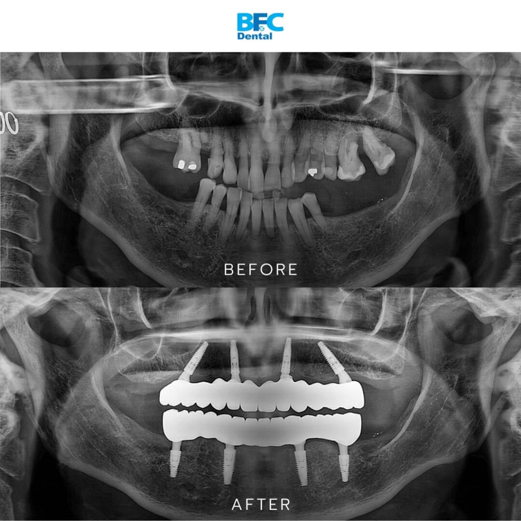 All-on-4 Dental Implants