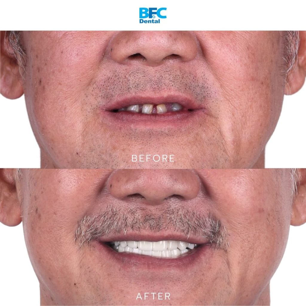 All-on-4 Implants