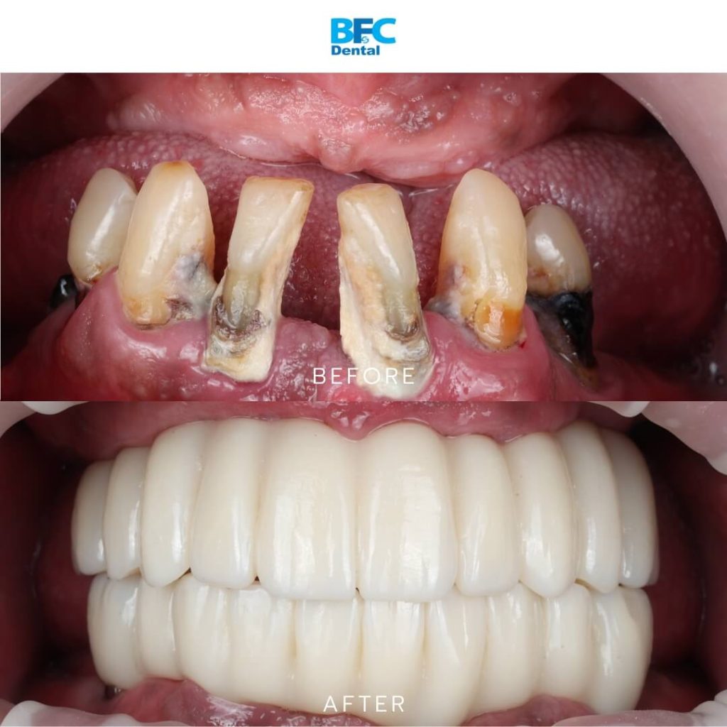 All-on-4 Implants