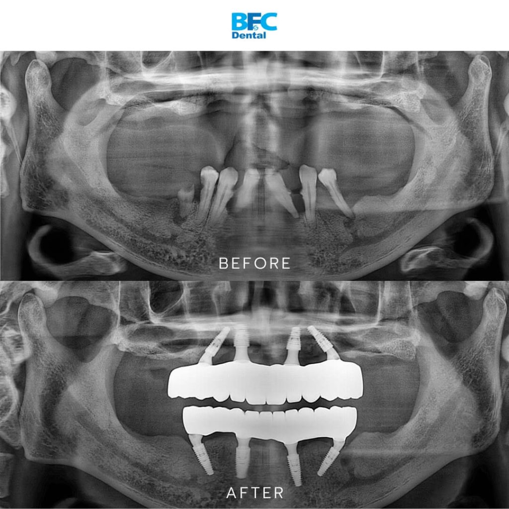 All-on-4 Implants