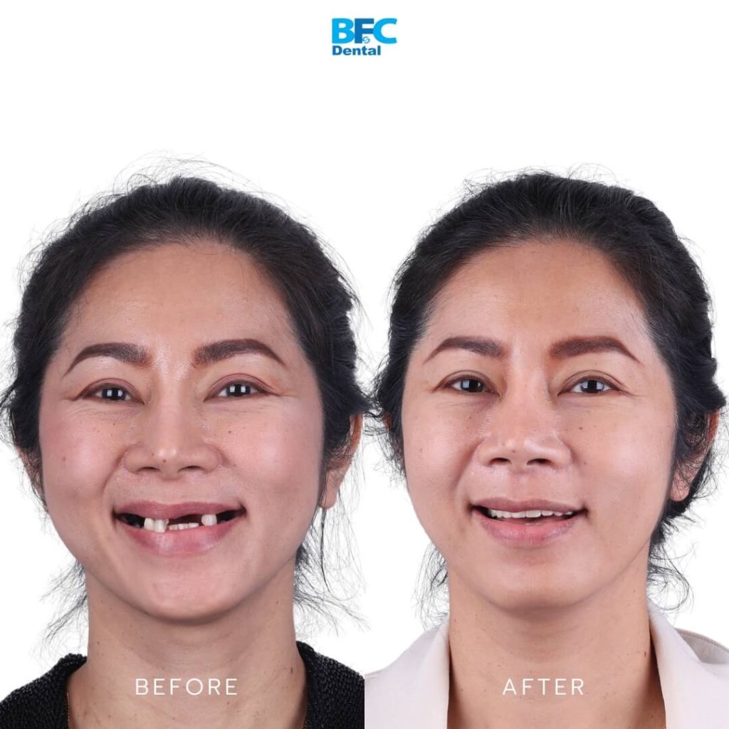 All-on-4 Full Mouth Implants