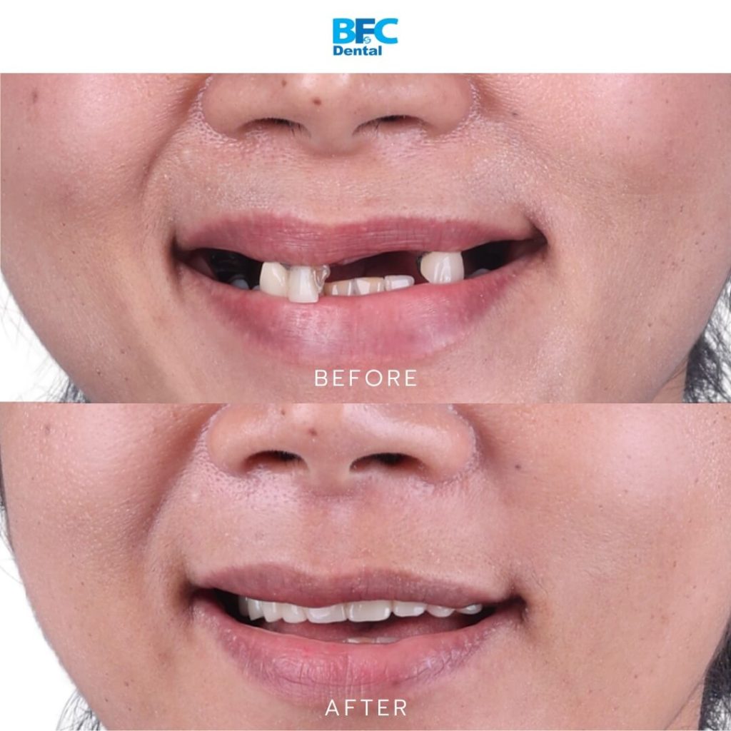 All-on-4 Full Mouth Implants