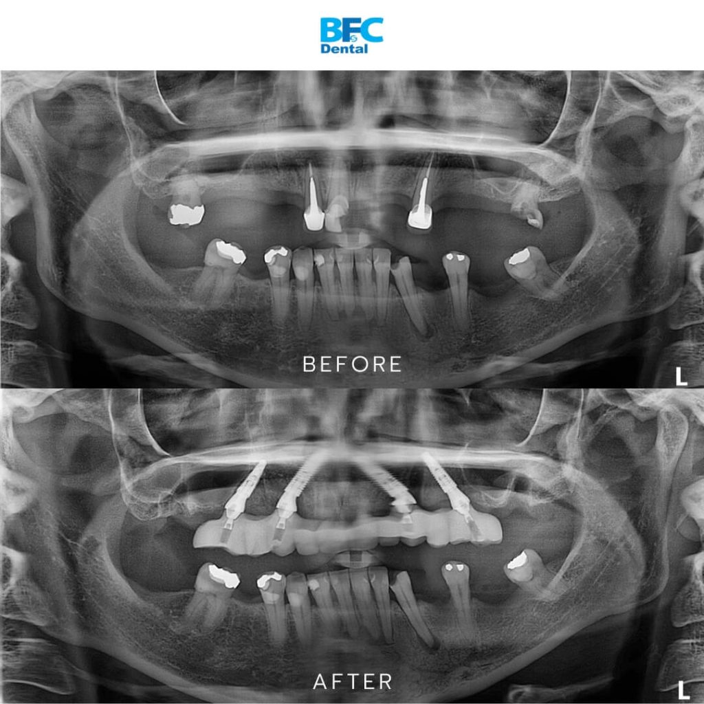 All-on-4 Full Mouth Implants