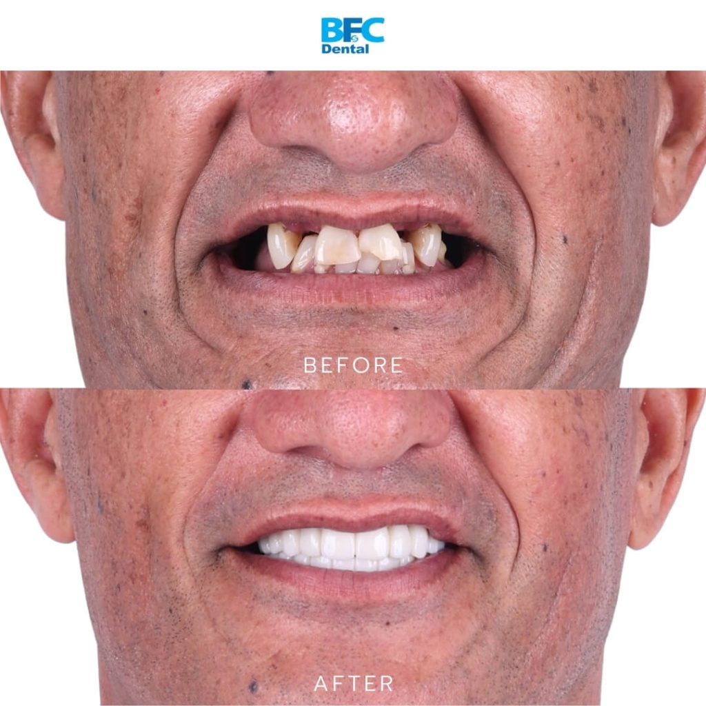 All-on-4 Full Mouth Implants