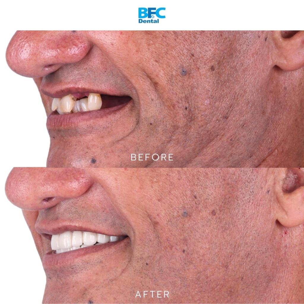 All-on-4 Full Mouth Implants