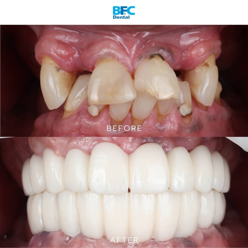 All-on-4 Full Mouth Implants