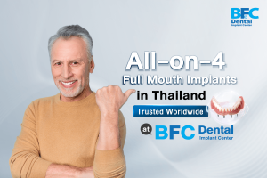 All-on-4 Full Mouth Implants