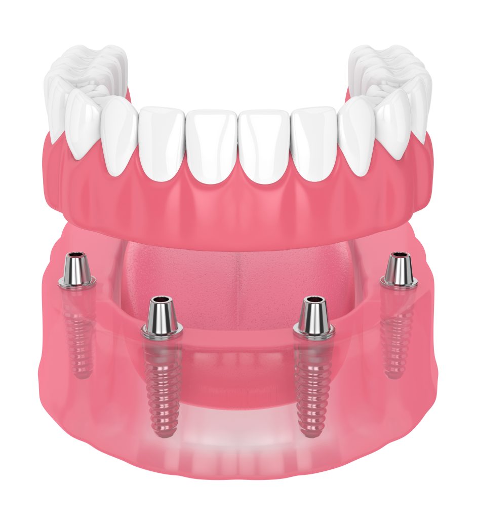 3-on-6 Dental Implants