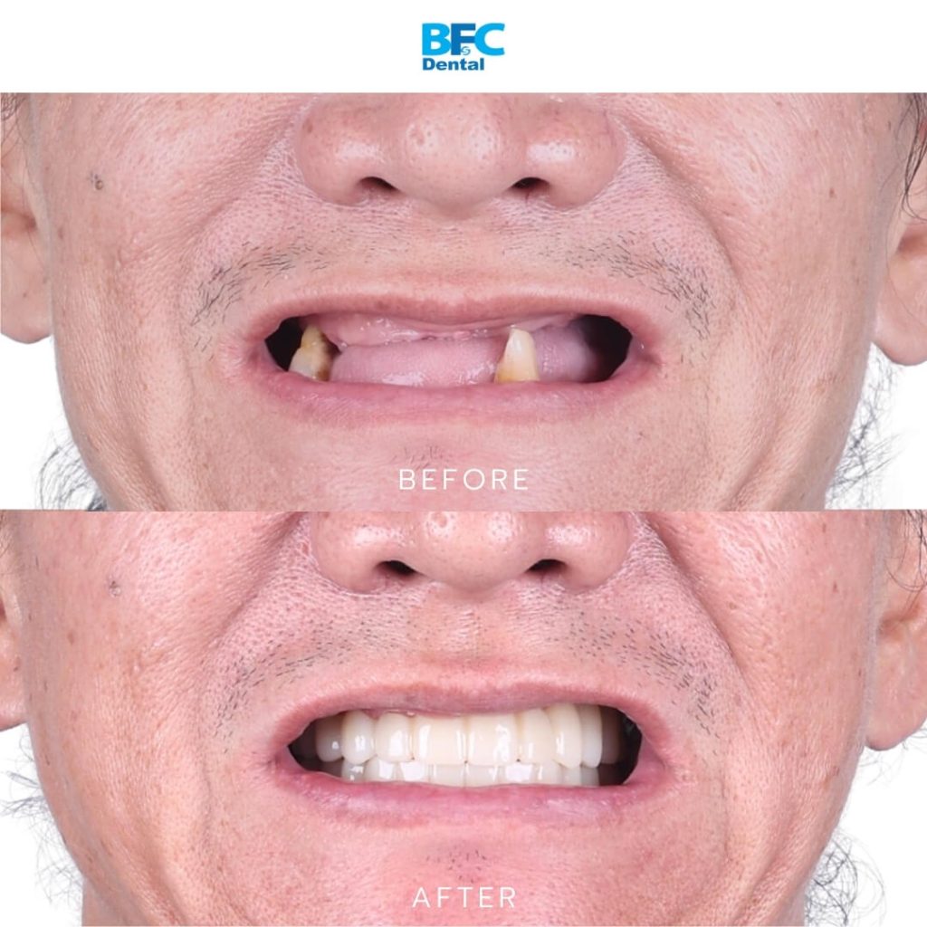 All-on-4 Full Mouth Implants