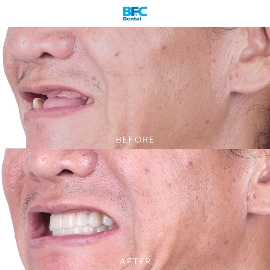 All-on-4 Full Mouth Implants