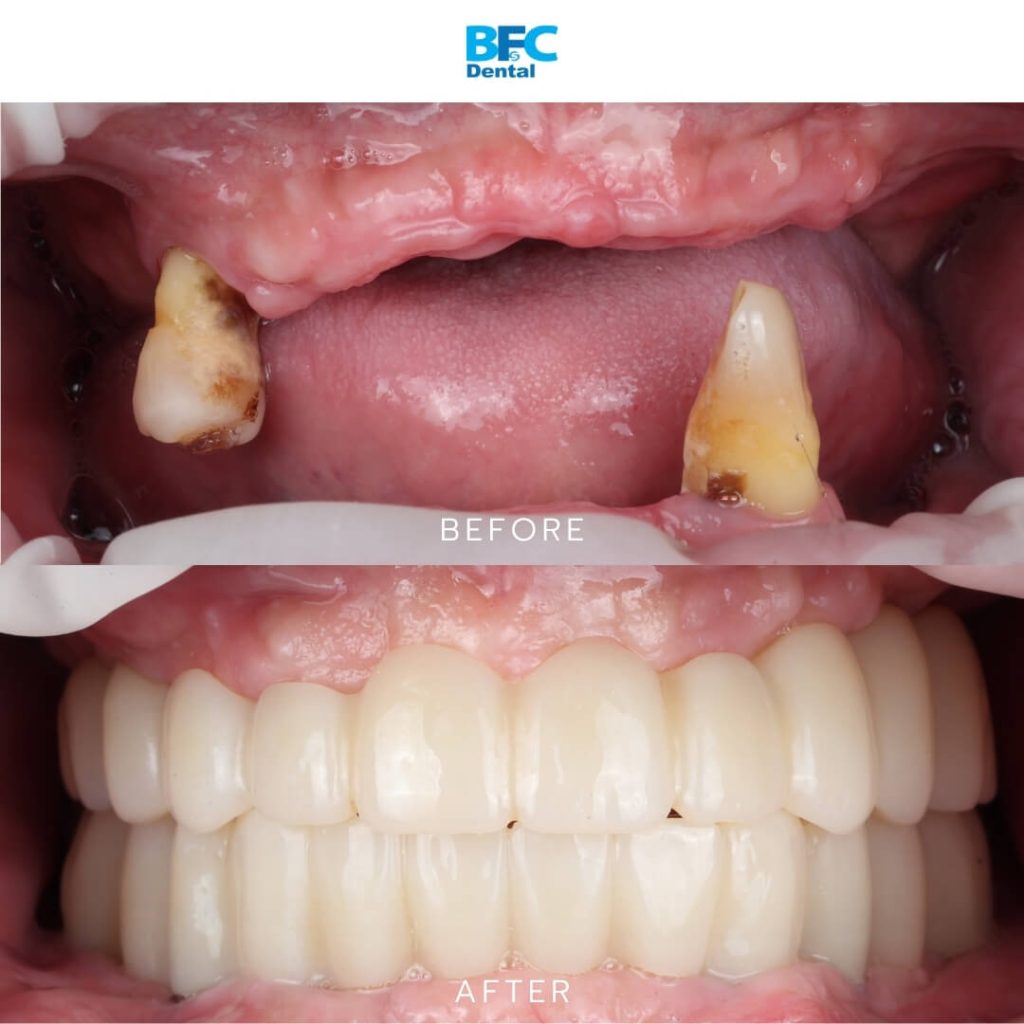 All-on-4 Full Mouth Implants