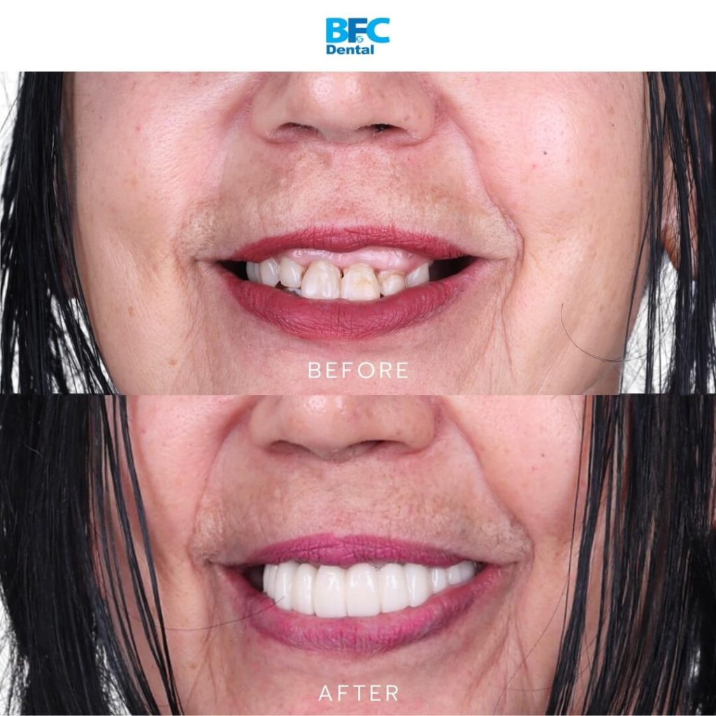 All-on-4 Implants with Palatal Approach