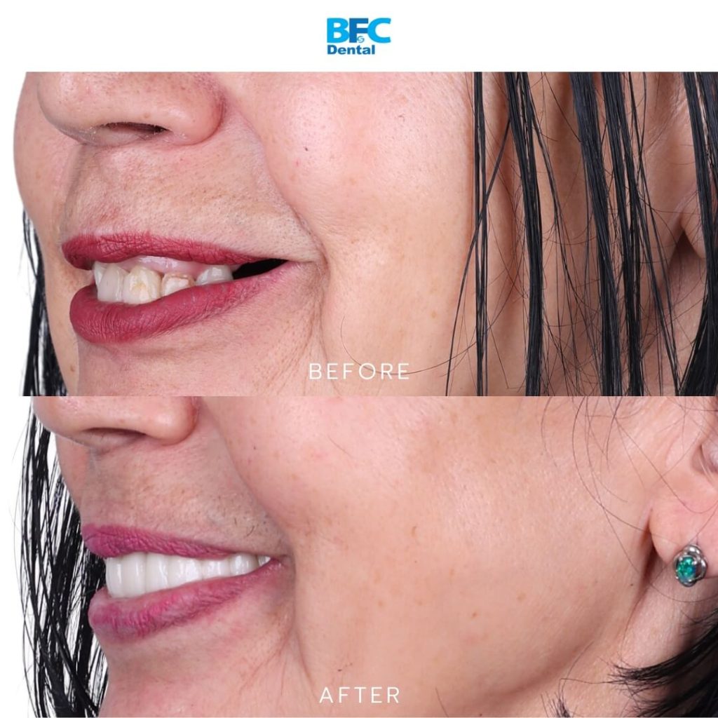 All-on-4 Implants with Palatal Approach