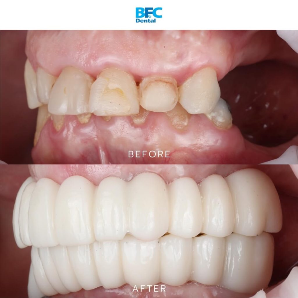 All-on-4 Implants with Palatal Approach