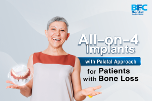 All-on-4 Implants with Palatal Approach