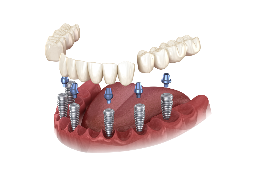 3-on-6 Full Mouth Dental Implants