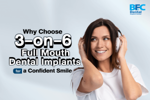 3-on-6 Full Mouth Dental Implants