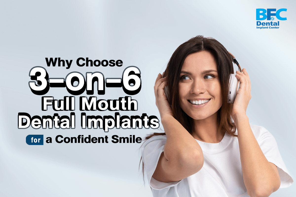 3-on-6 Full Mouth Dental Implants