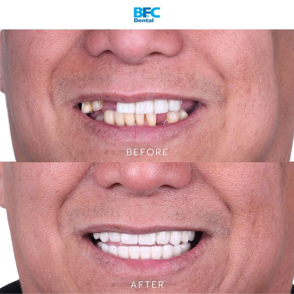All-on-4 Full Mouth Implants