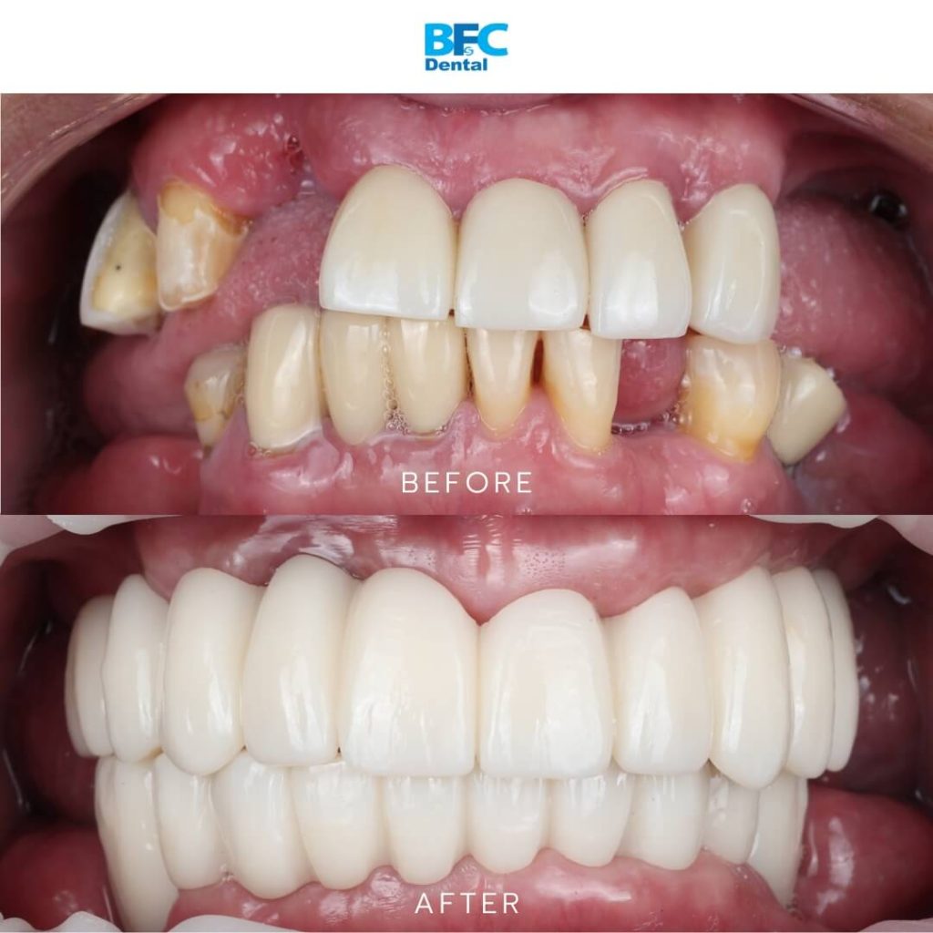 All-on-4 Full Mouth Implants