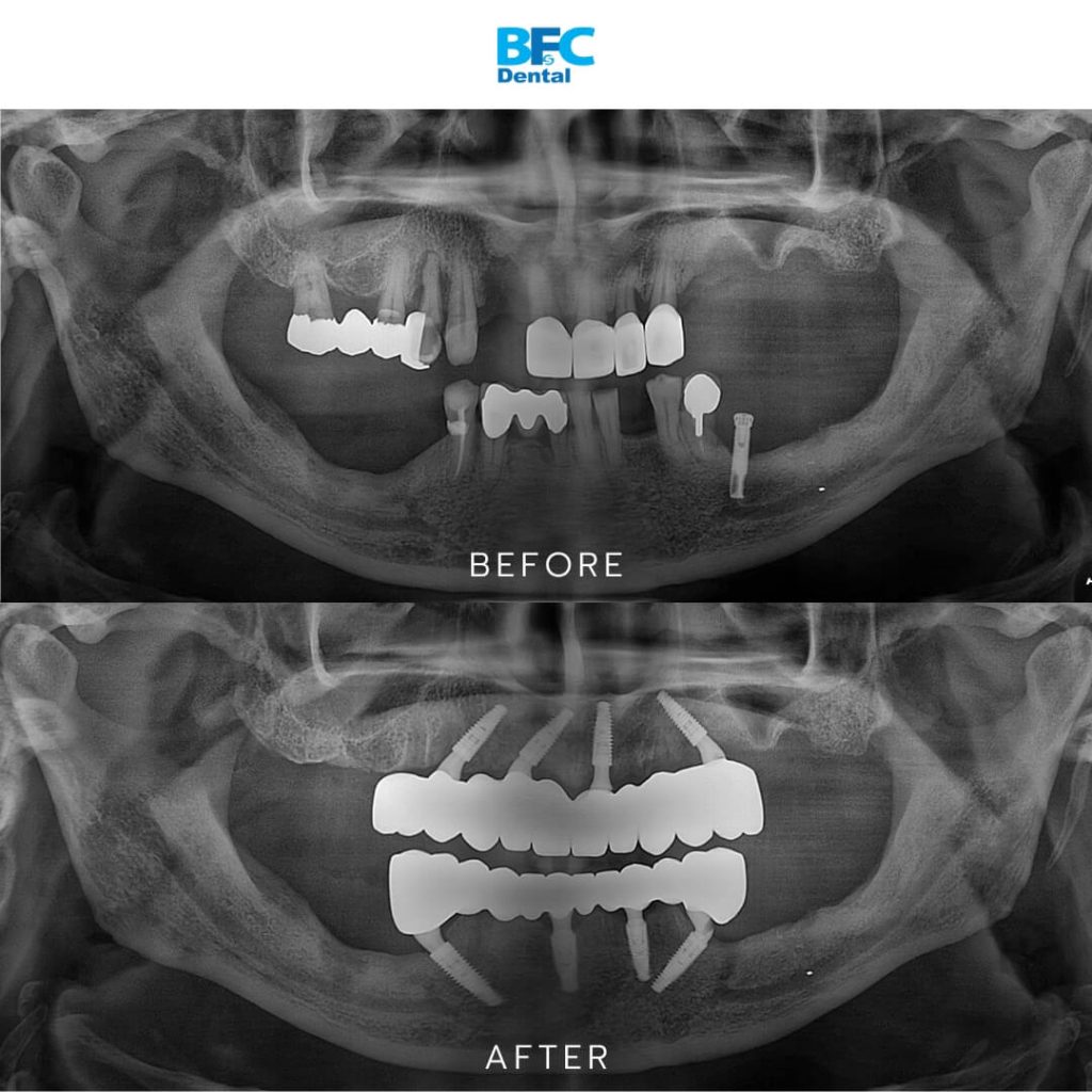 All-on-4 Full Mouth Implants