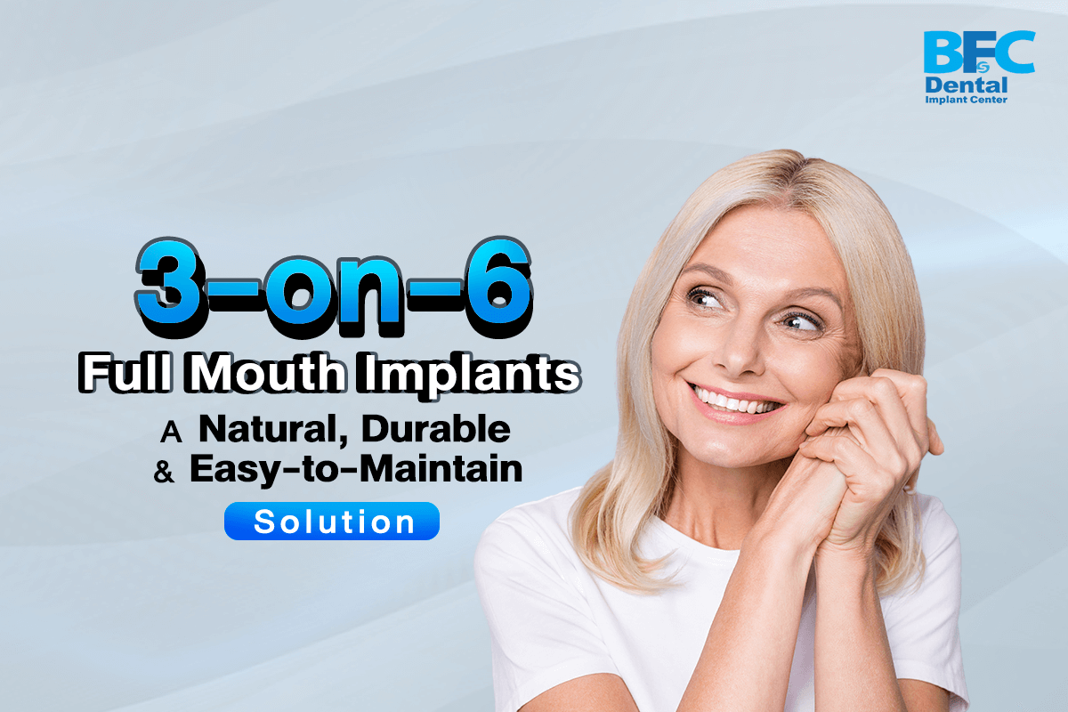 3-on-6 Full Mouth Implants