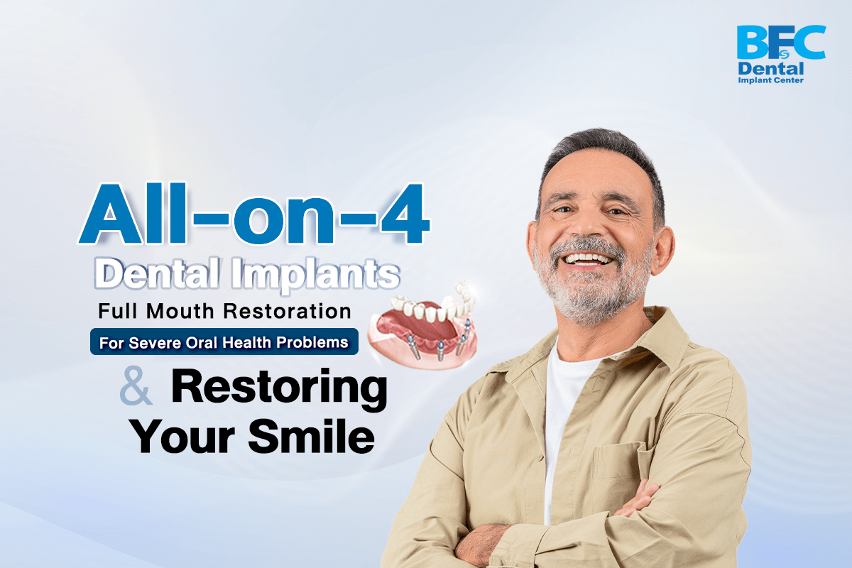 All-on-4 Dental Implants