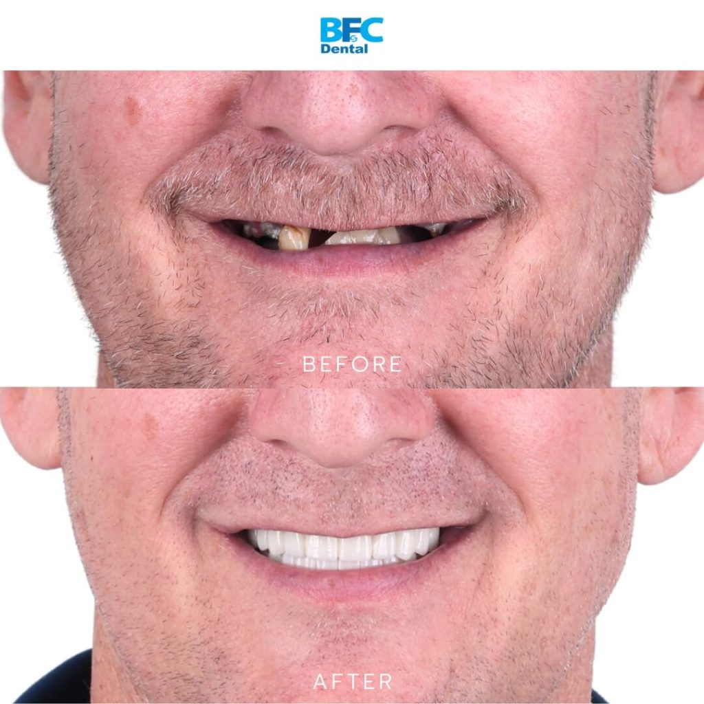 All-on-4 Full Mouth Implants