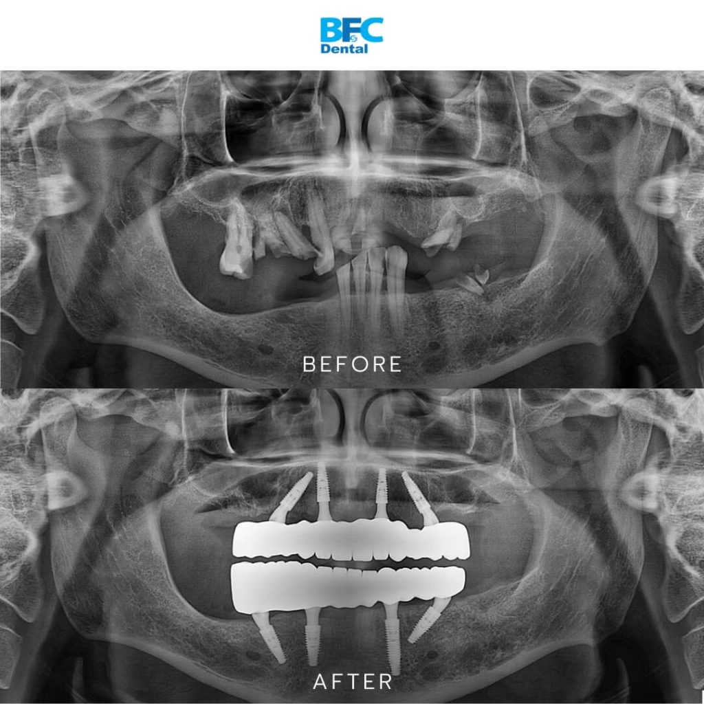 All-on-4 Full Mouth Implants
