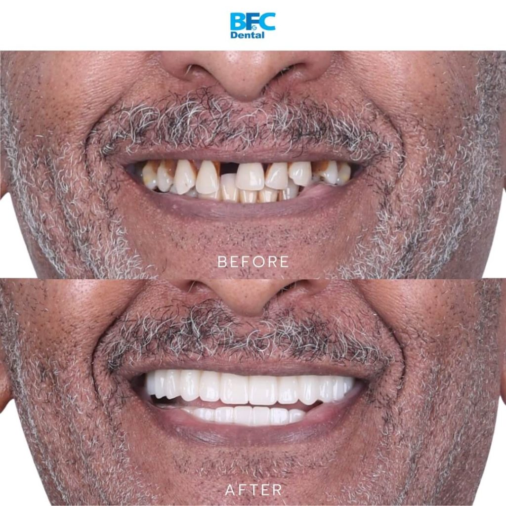 All-on-4 Dental Implants