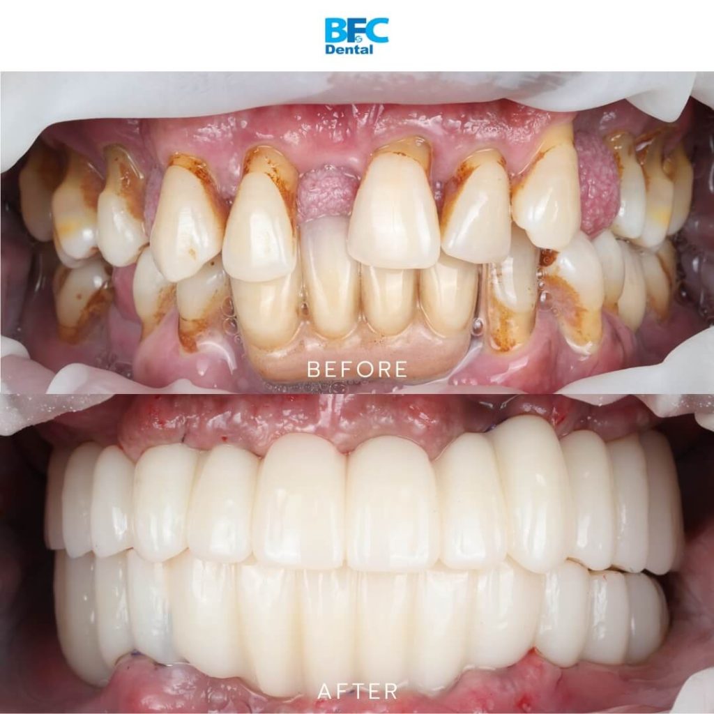 All-on-4 Dental Implants