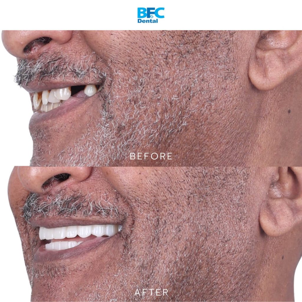 All-on-4 Dental Implants