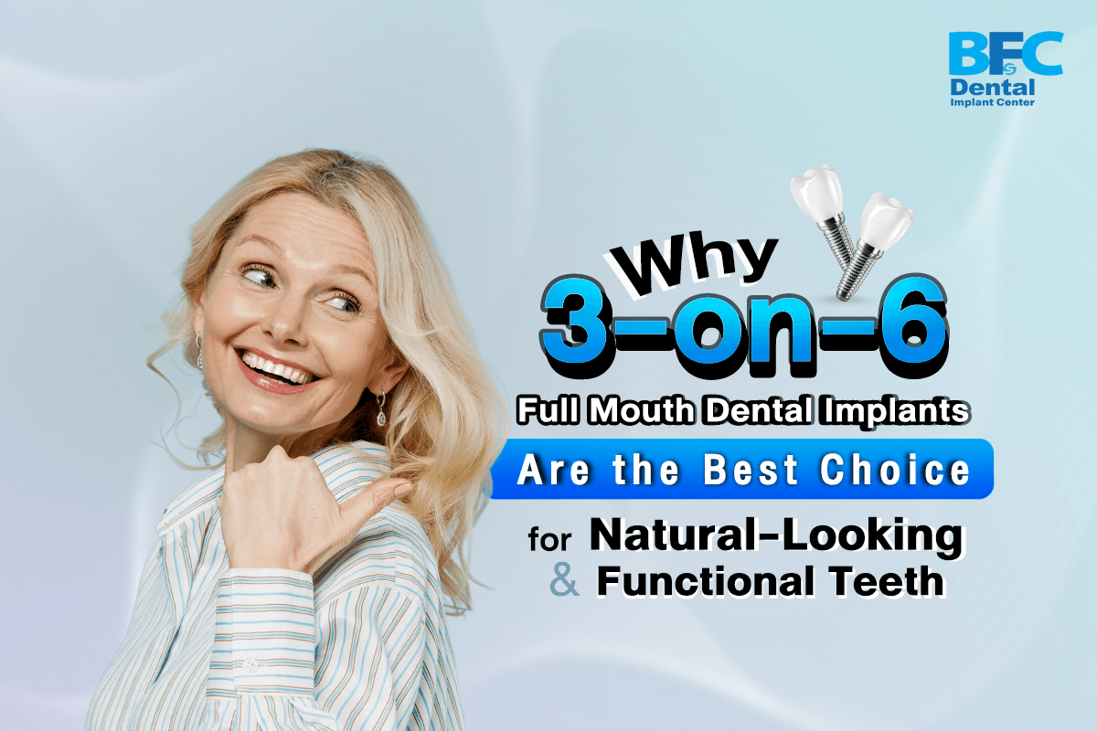 3-on-6 Full Mouth Dental Implants