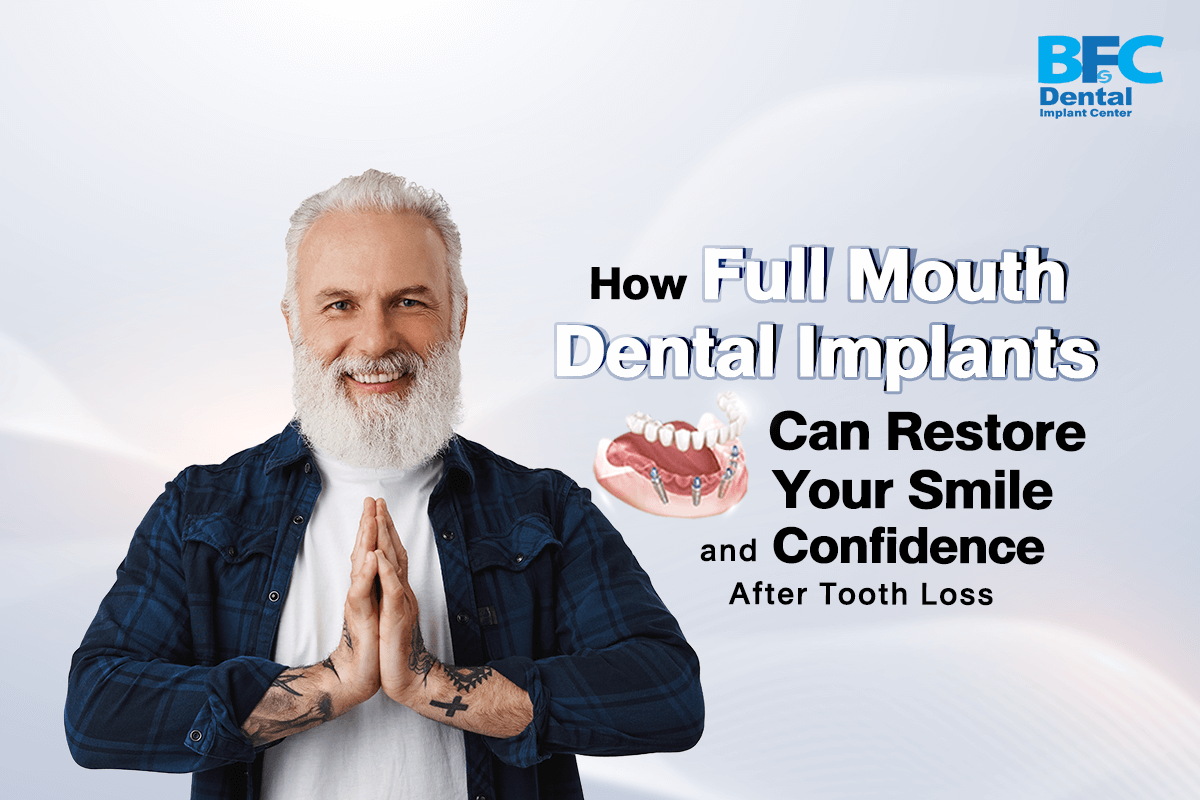 Full Mouth Dental Implants