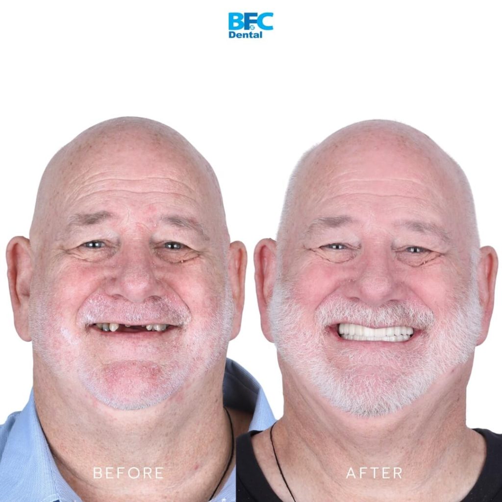 Full Mouth Dental Implants 