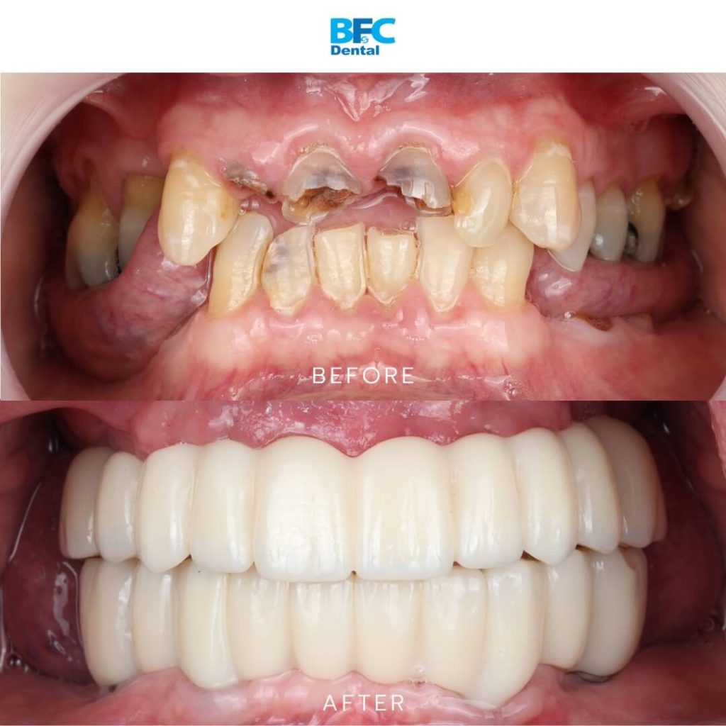 Full Mouth Dental Implants 