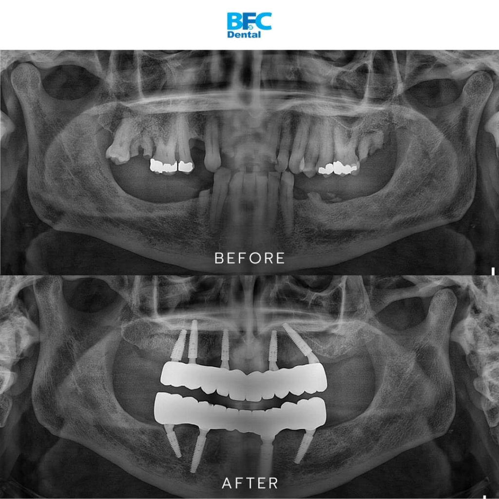 Full Mouth Dental Implants 