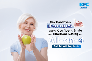 All-on-4 Full Mouth Implants