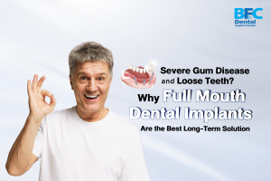 Full Mouth Dental Implants