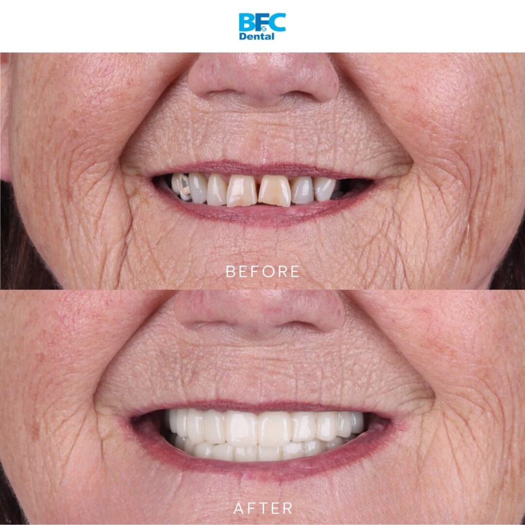 All-on-4 Full Arch Dental Implants