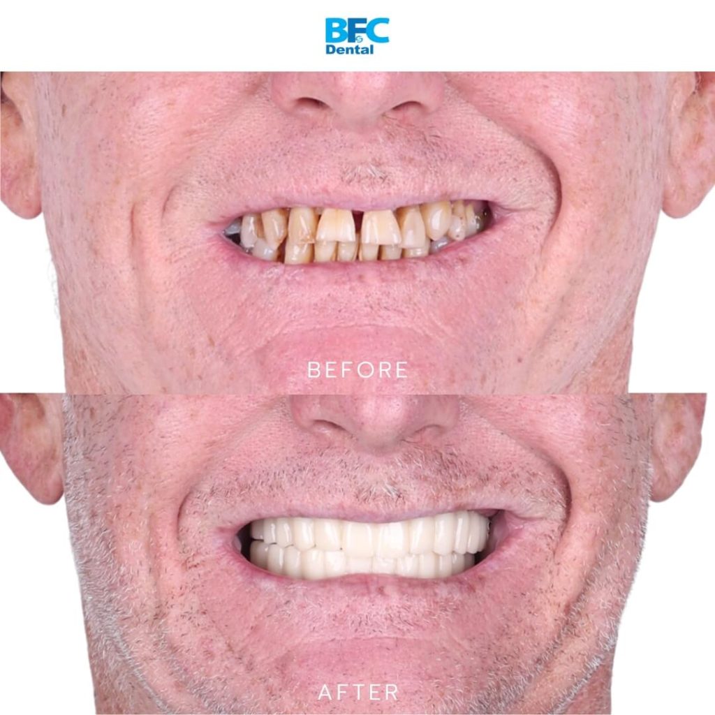 Full Mouth Dental Implants