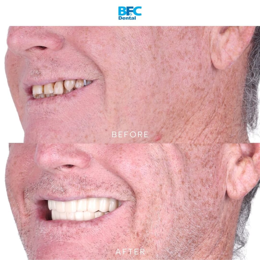 Full Mouth Dental Implants