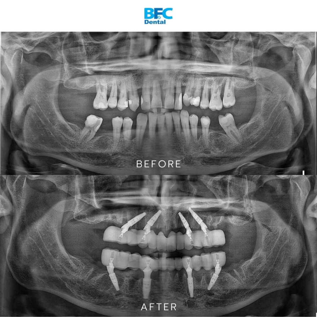 Full Mouth Dental Implants