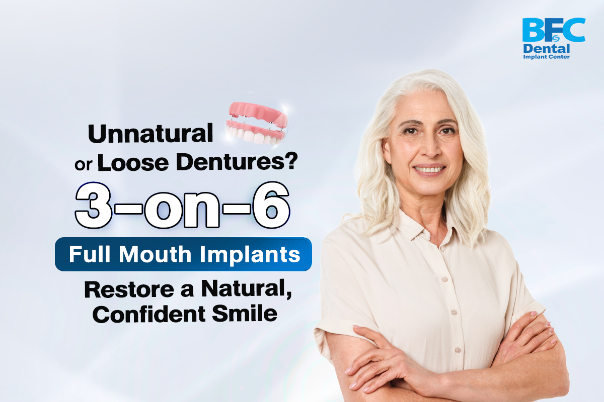 3-on-6 Full Mouth Implants