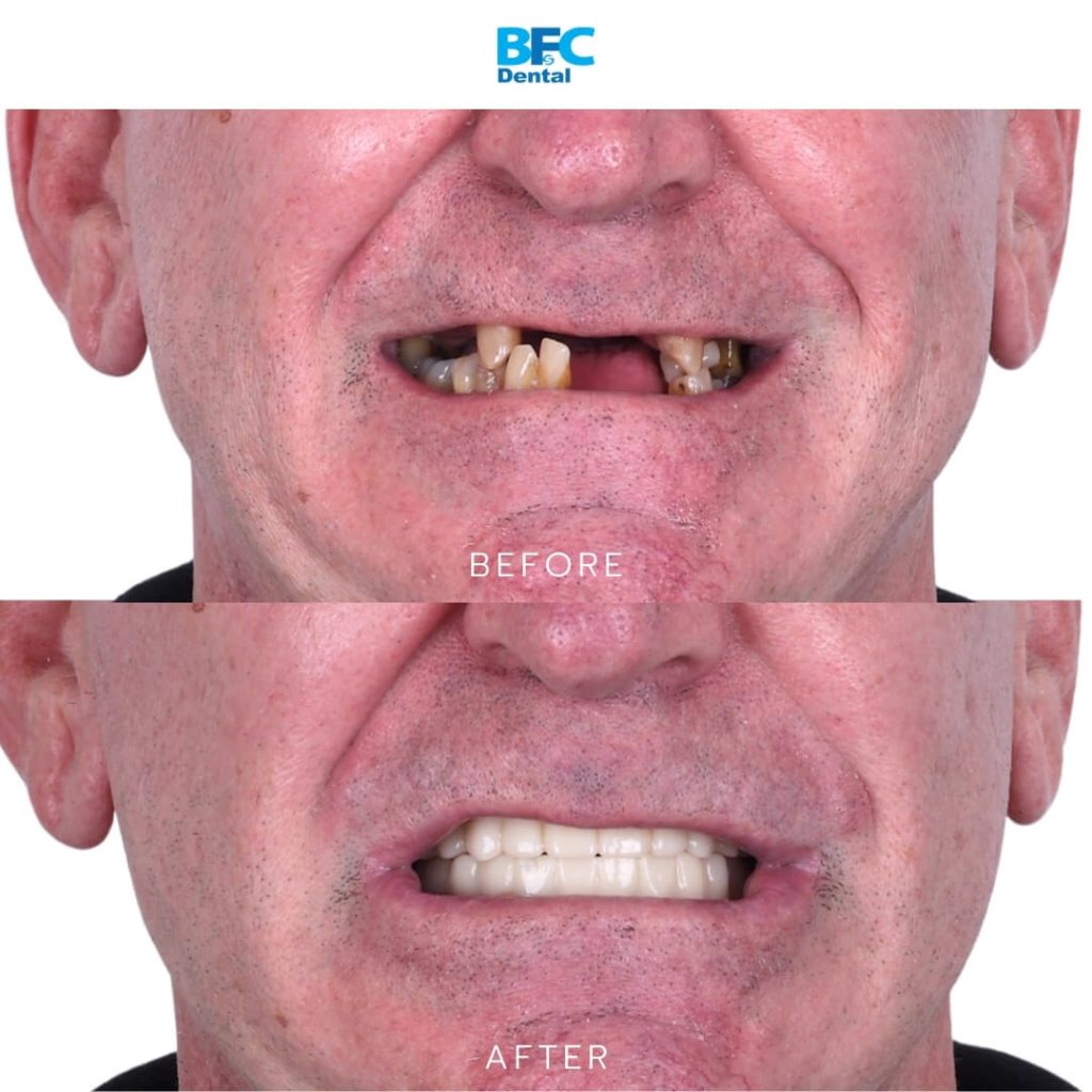 Full Mouth Dental Implants