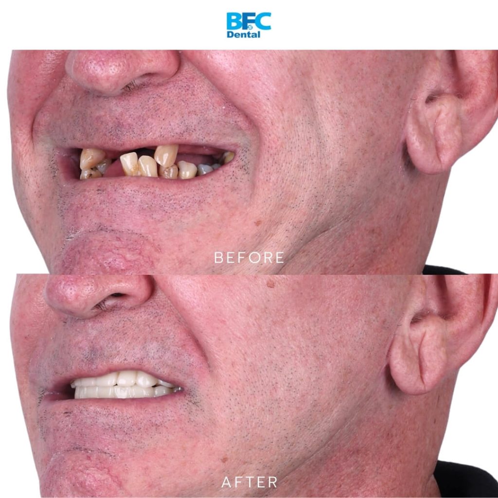 Full Mouth Dental Implants